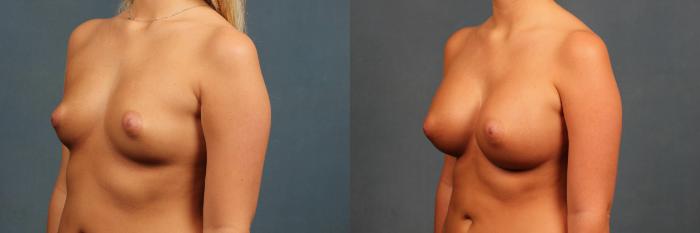 Before & After Enlargement - Silicone Case 347 View #4 View in Louisville & Lexington, KY
