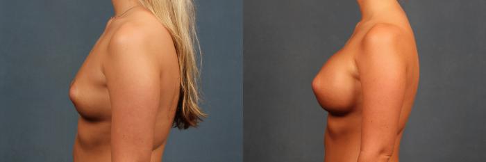 Before & After Enlargement - Silicone Case 347 View #5 View in Louisville & Lexington, KY
