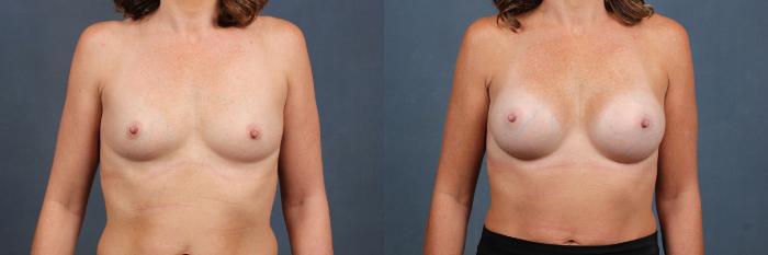 Before & After Enlargement - Silicone Case 348 View #1 View in Louisville & Lexington, KY