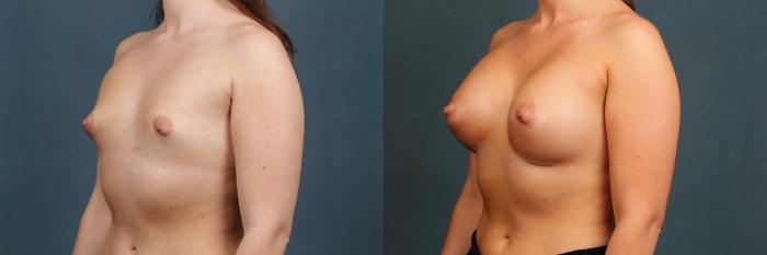 Before & After Enlargement - Silicone Case 349 View #2 View in Louisville & Lexington, KY