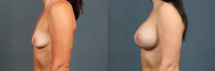 Before & After Enlargement - Silicone Case 350 View #3 View in Louisville & Lexington, KY