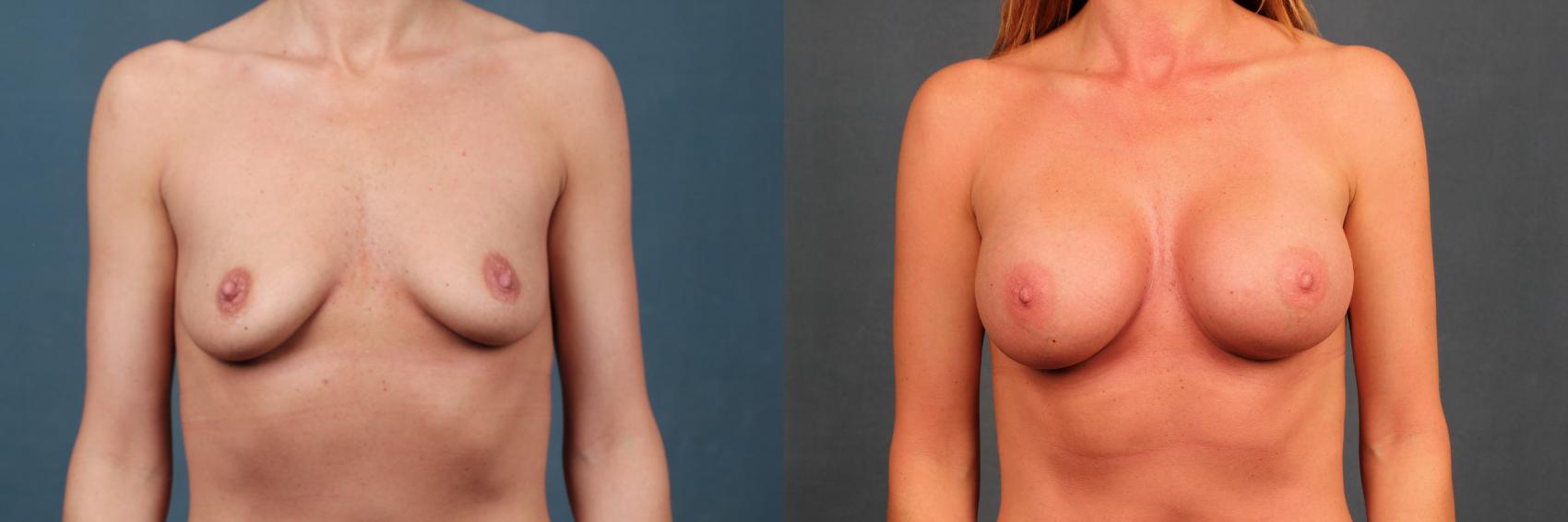 Before & After Enlargement - Silicone Case 351 View #1 View in Louisville, KY