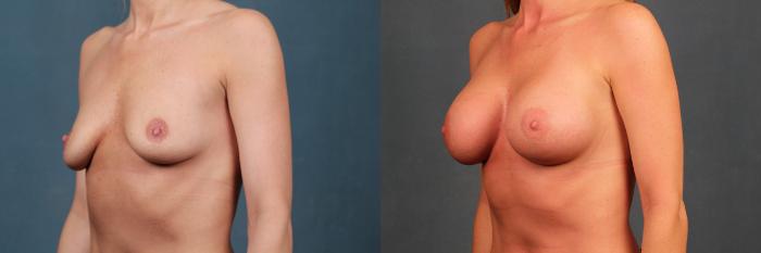 Before & After Enlargement - Silicone Case 351 View #2 View in Louisville & Lexington, KY