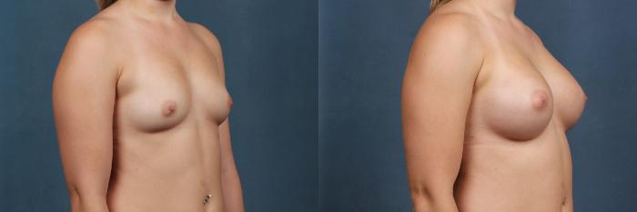 Before & After Enlargement - Silicone Case 352 View #2 View in Louisville & Lexington, KY