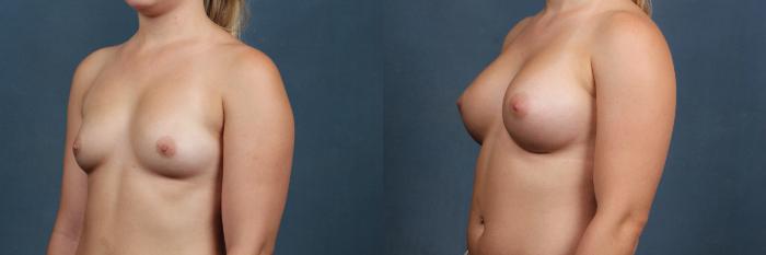 Before & After Enlargement - Silicone Case 352 View #3 View in Louisville & Lexington, KY