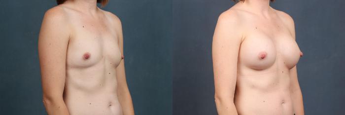 Before & After Enlargement - Silicone Case 353 View #3 View in Louisville & Lexington, KY