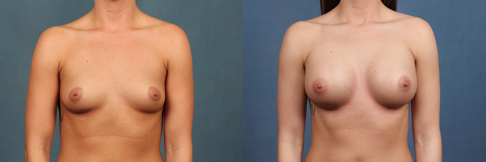 Before & After Enlargement - Silicone Case 354 View #1 View in Louisville & Lexington, KY