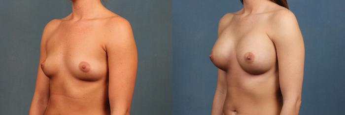 Before & After Enlargement - Silicone Case 354 View #2 View in Louisville & Lexington, KY
