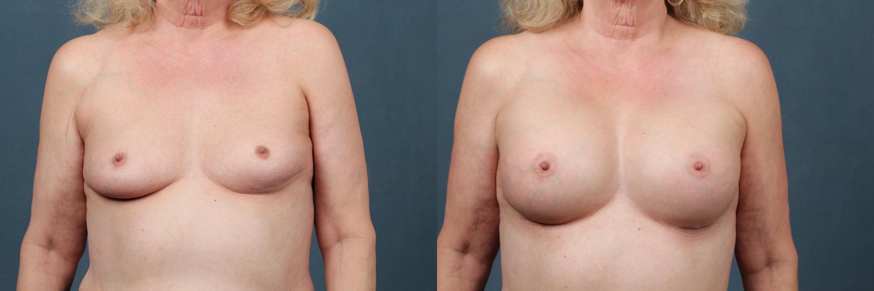 Before & After Enlargement - Silicone Case 355 View #1 View in Louisville & Lexington, KY