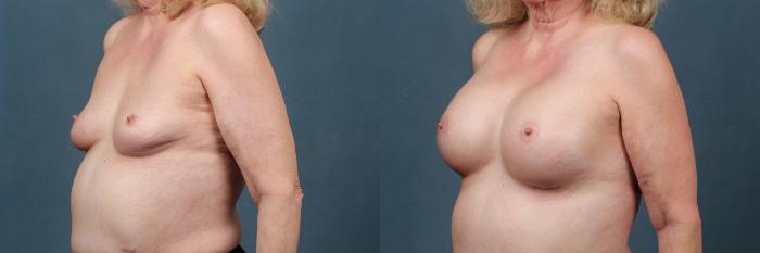 Before & After Enlargement - Silicone Case 355 View #2 View in Louisville & Lexington, KY