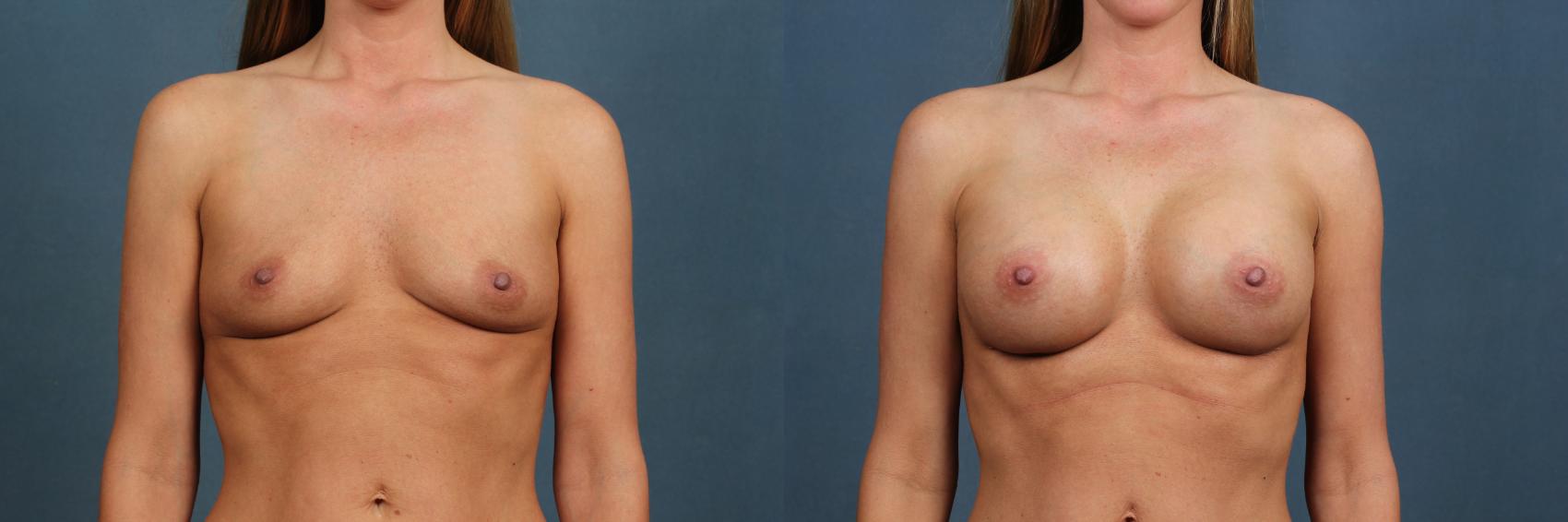 Before & After Enlargement - Silicone Case 358 View #1 View in Louisville & Lexington, KY