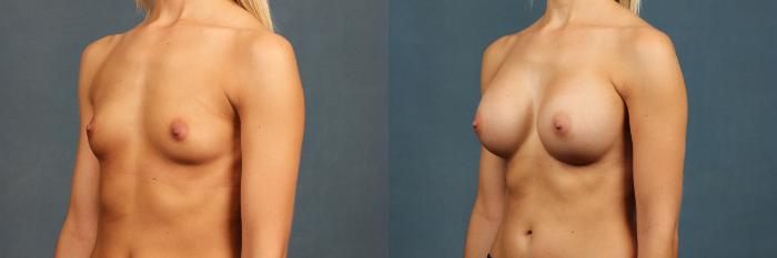Before & After Enlargement - Silicone Case 359 View #2 View in Louisville & Lexington, KY