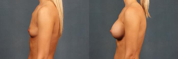 Before & After Enlargement - Silicone Case 359 View #3 View in Louisville & Lexington, KY