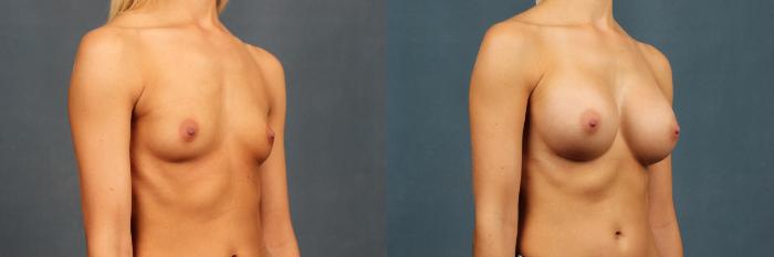 Before & After Enlargement - Silicone Case 359 View #4 View in Louisville & Lexington, KY
