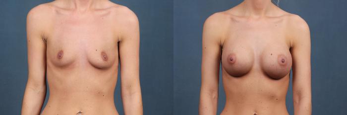 Before & After Enlargement - Silicone Case 360 View #1 View in Louisville & Lexington, KY