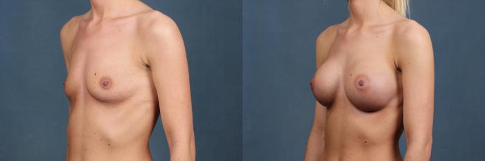 Before & After Enlargement - Silicone Case 360 View #4 View in Louisville & Lexington, KY