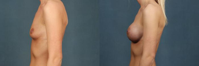 Before & After Enlargement - Silicone Case 360 View #5 View in Louisville & Lexington, KY