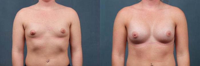 Before & After Enlargement - Silicone Case 361 View #1 View in Louisville & Lexington, KY