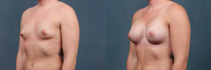 Before & After Enlargement - Silicone Case 361 View #2 View in Louisville & Lexington, KY