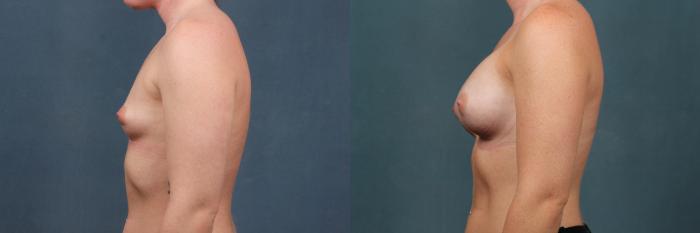 Before & After Enlargement - Silicone Case 361 View #3 View in Louisville & Lexington, KY