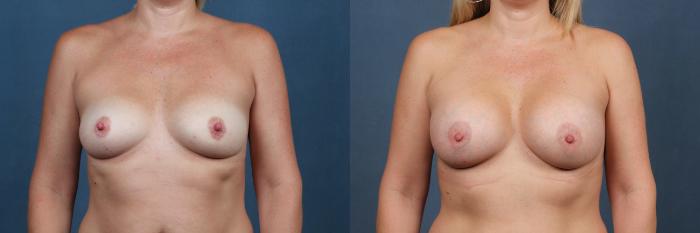 Before & After Enlargement - Silicone Case 362 View #1 View in Louisville & Lexington, KY