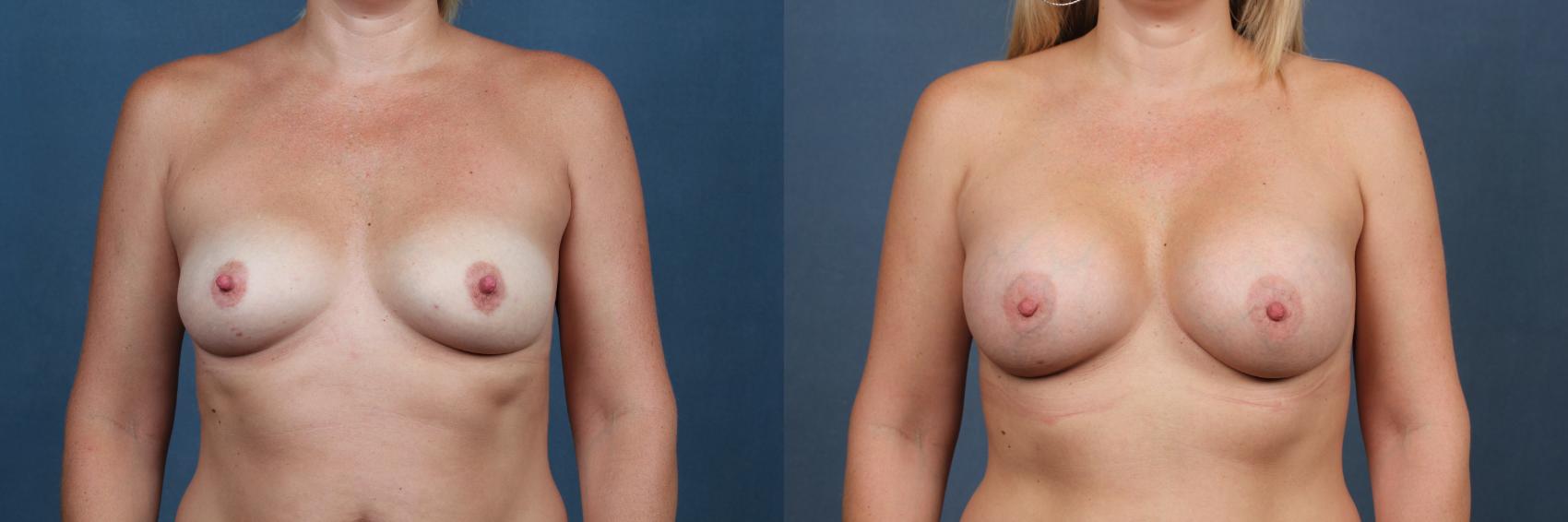 Before & After Enlargement - Silicone Case 363 View #1 View in Louisville & Lexington, KY