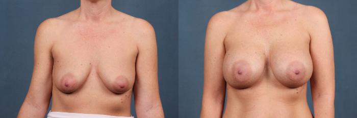 Before & After Enlargement - Silicone Case 364 View #1 View in Louisville & Lexington, KY