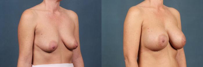 Before & After Enlargement - Silicone Case 364 View #2 View in Louisville & Lexington, KY
