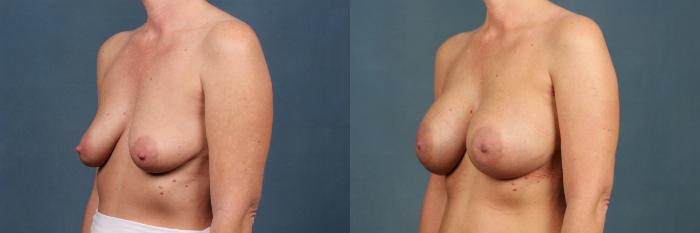 Before & After Enlargement - Silicone Case 364 View #3 View in Louisville & Lexington, KY