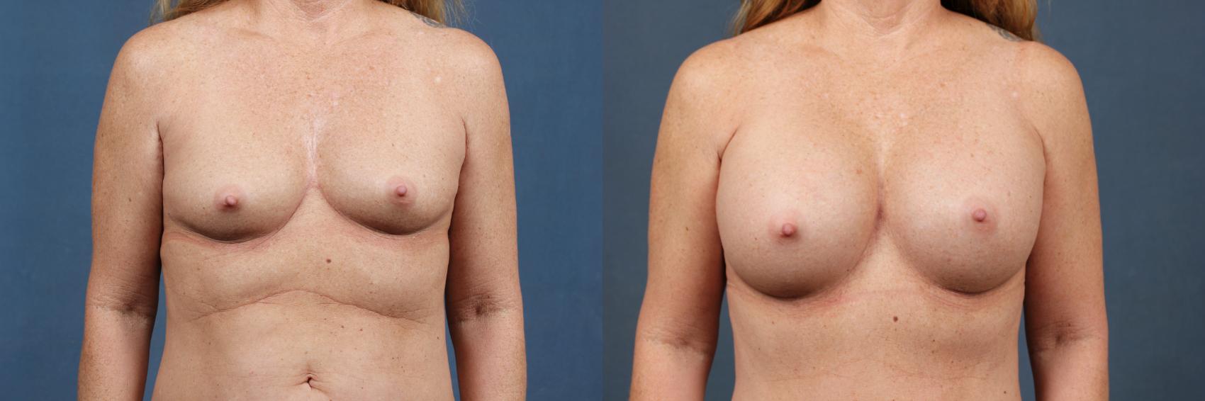 Before & After Enlargement - Silicone Case 366 View #1 View in Louisville & Lexington, KY