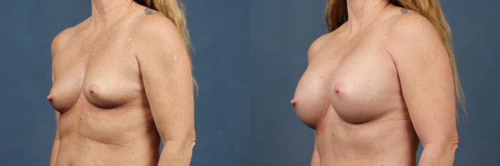 Before & After Enlargement - Silicone Case 366 View #2 View in Louisville & Lexington, KY