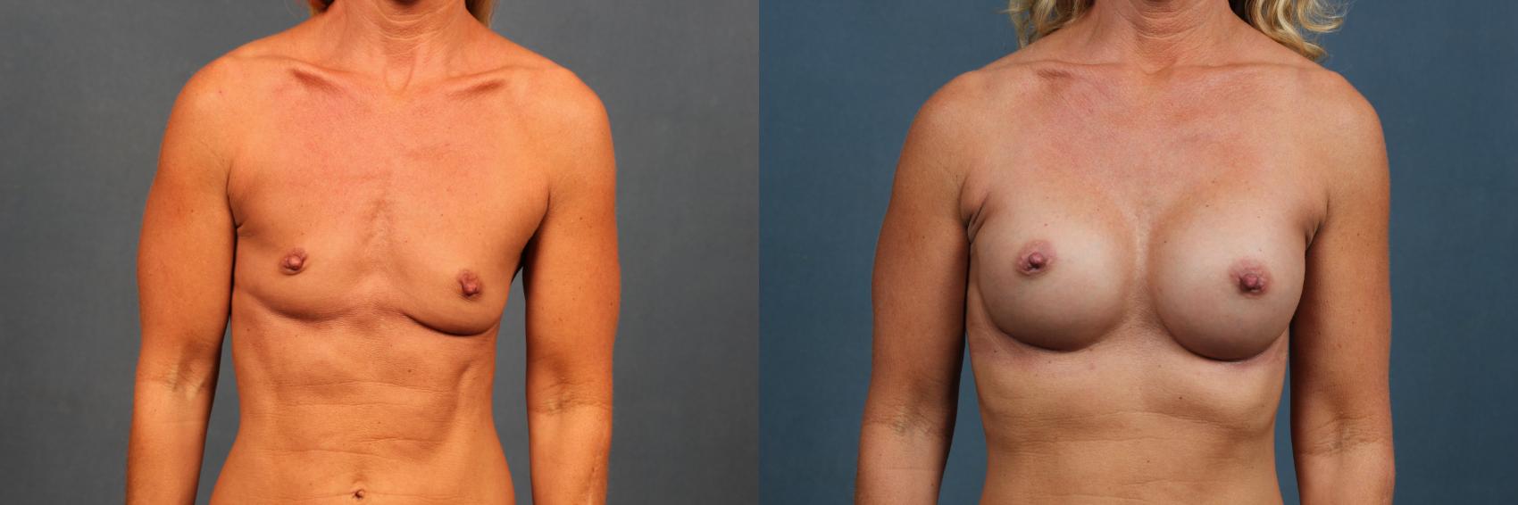 Before & After Enlargement - Silicone Case 367 View #1 View in Louisville & Lexington, KY