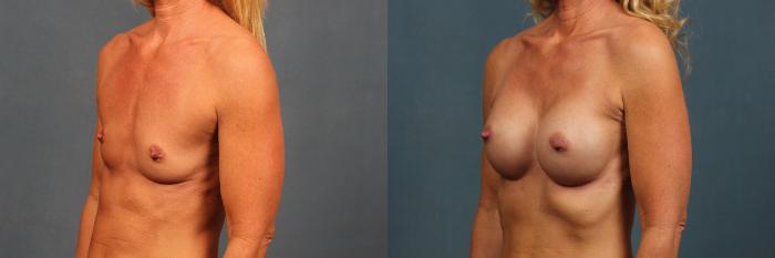 Before & After Enlargement - Silicone Case 367 View #4 View in Louisville & Lexington, KY