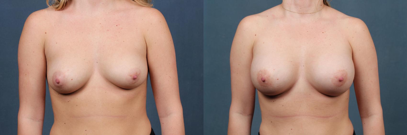 Before & After Enlargement - Silicone Case 368 View #1 View in Louisville & Lexington, KY