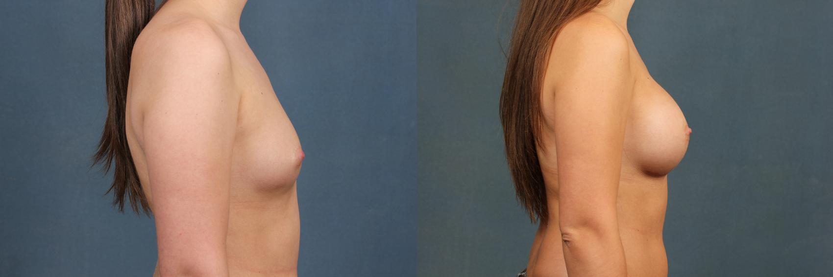 Before & After Enlargement - Silicone Case 369 View #3 View in Louisville & Lexington, KY