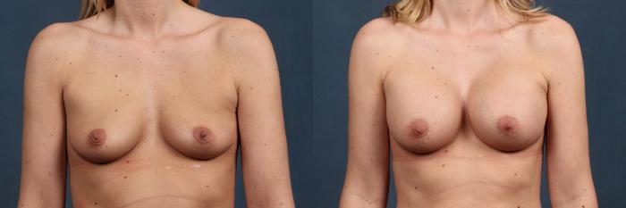 Before & After Enlargement - Silicone Case 370 View #1 View in Louisville & Lexington, KY