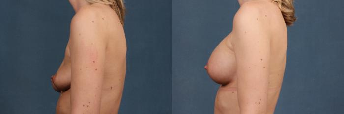Before & After Enlargement - Silicone Case 370 View #3 View in Louisville & Lexington, KY