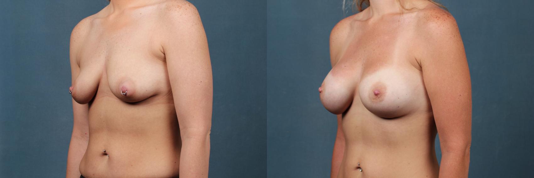 Before & After Enlargement - Silicone Case 371 View #2 View in Louisville & Lexington, KY