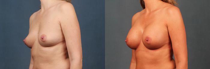 Before & After Enlargement - Silicone Case 372 View #2 View in Louisville & Lexington, KY
