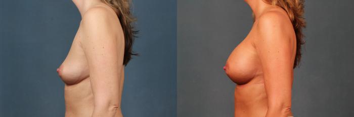 Before & After Enlargement - Silicone Case 372 View #3 View in Louisville & Lexington, KY