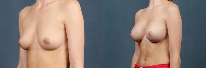 Before & After Enlargement - Silicone Case 373 View #2 View in Louisville & Lexington, KY