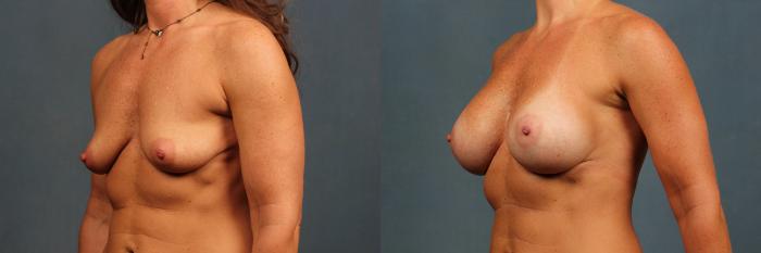 Before & After Enlargement - Silicone Case 374 View #2 View in Louisville & Lexington, KY