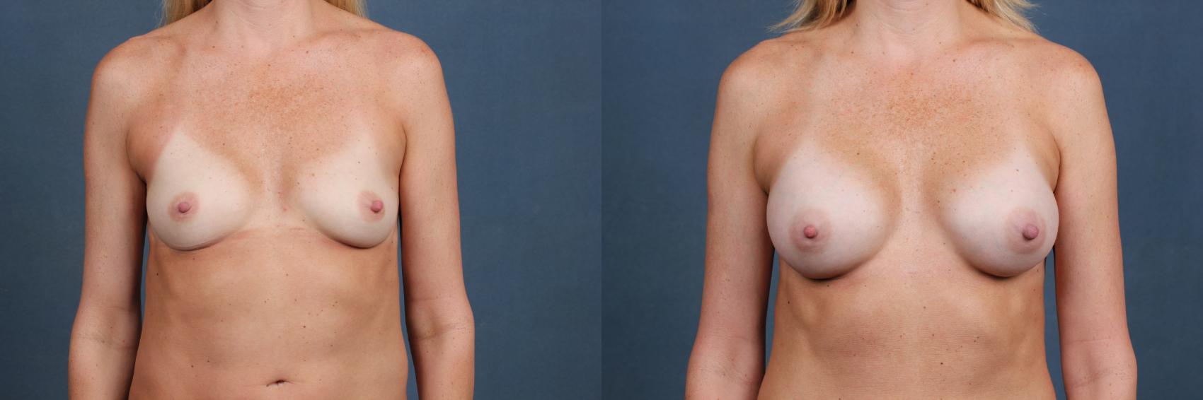 Before & After Enlargement - Silicone Case 375 View #1 View in Louisville, KY