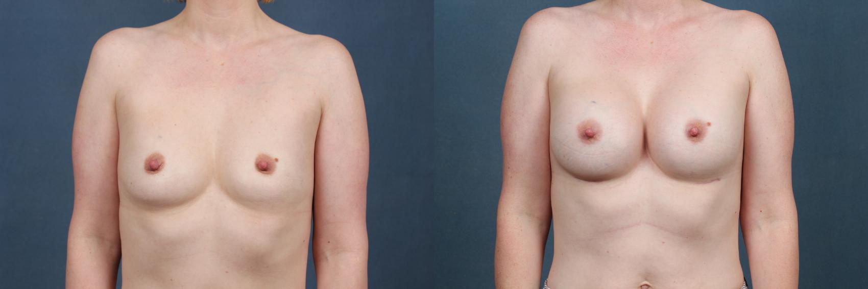 Before & After Enlargement - Silicone Case 376 View #1 View in Louisville & Lexington, KY