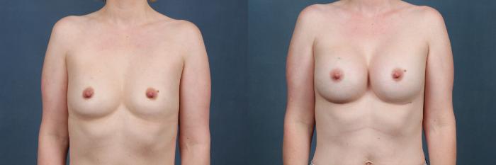 Before & After Enlargement - Silicone Case 376 View #1 View in Louisville & Lexington, KY