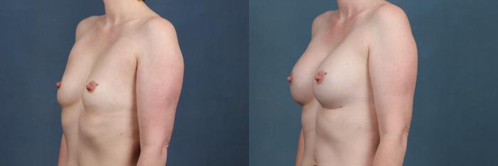 Before & After Enlargement - Silicone Case 376 View #2 View in Louisville & Lexington, KY