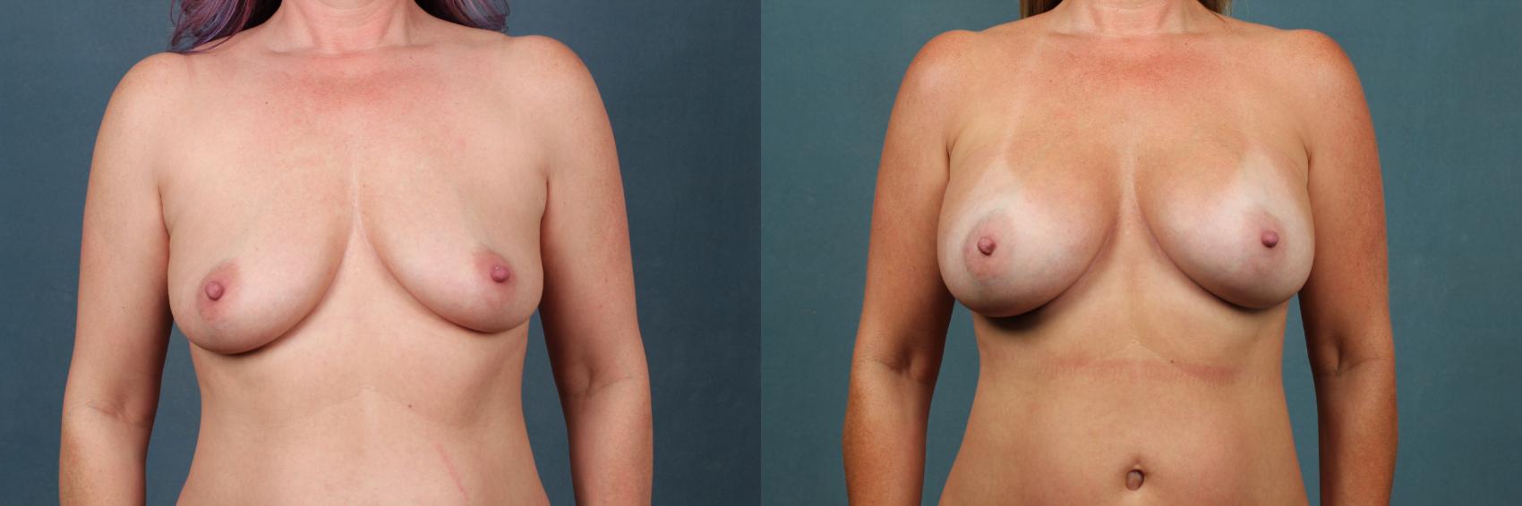Before & After Enlargement - Silicone Case 377 View #1 View in Louisville & Lexington, KY