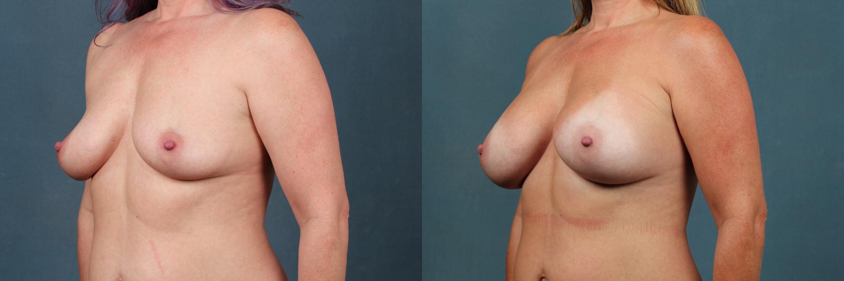 Before & After Enlargement - Silicone Case 377 View #2 View in Louisville & Lexington, KY