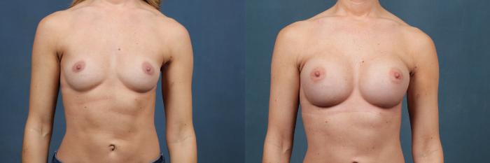Before & After Enlargement - Silicone Case 378 View #1 View in Louisville & Lexington, KY