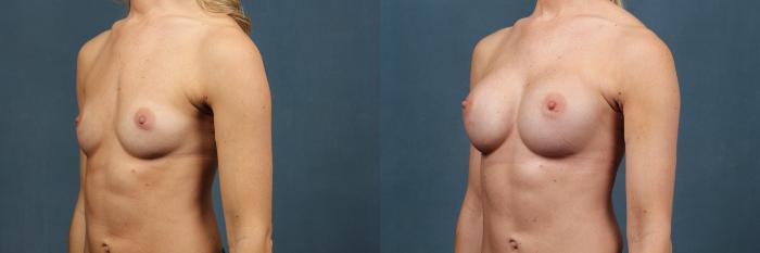Before & After Enlargement - Silicone Case 378 View #2 View in Louisville & Lexington, KY